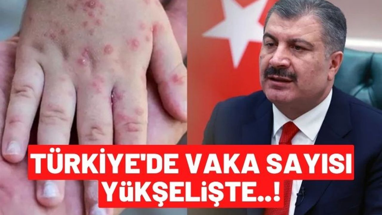 Türkiye Alarmda: Fahrettin Koca'dan Maymun Çiçeği Açıklaması! Pandemi Geliyor Mu?