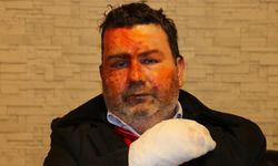 Uykusundayken Yüzüne Yanıcı Madde Döküldü