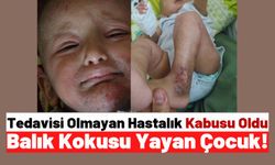 Nadir Görülen Hastalık: Güneşe Çıkamayan Küçük Çocuk Balık Kokusu Yayıyor!