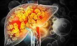 Karaciğer Yağlanması: Nedir, Nasıl Anlaşılır, Belirtileri ve Tedavisi