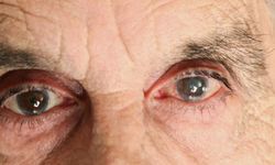 Gözlerdeki Sis Perdesi Katarakt: Katarakt Belirtileri ve Tedavisi