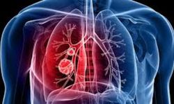 Dünya nüfusunun yaklaşık üçte biri hangi hastalığın gizli taşıyıcısıdır?