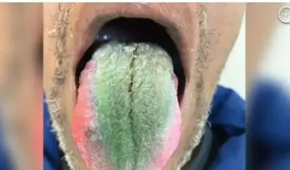 64 Yaşındaki Adamın Dili Yeşillendi Ve Tüylendi! Sebebi Sigara Mı?