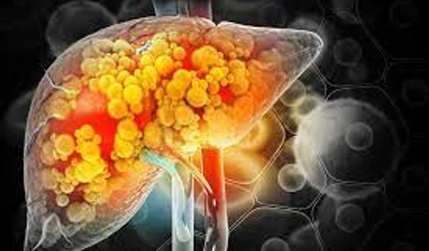 Karaciğer Yağlanması: Nedir, Nasıl Anlaşılır, Belirtileri ve Tedavisi